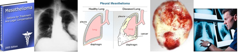 All About Mesothelioma : Video - Lawyer - Cancer ...