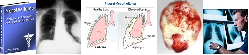 mesothelioma